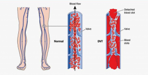 Deep Vein Thrombosis (DVT) – Dr Marek Sepiolo