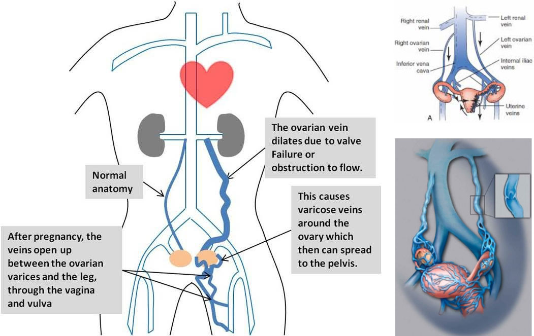 pelvic-congestion-syndrome-pcs-dr-marek-sepiolo