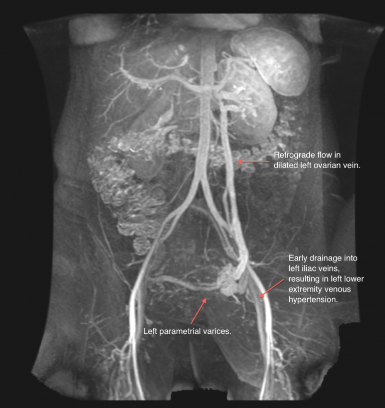 Pelvic congestion syndrome что это