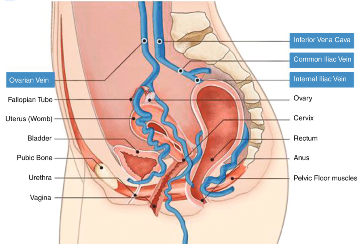 Vulvar Varicosities: Managing Varicose Veins Of The Vulva During Pregnancy  – Damiva Diaries